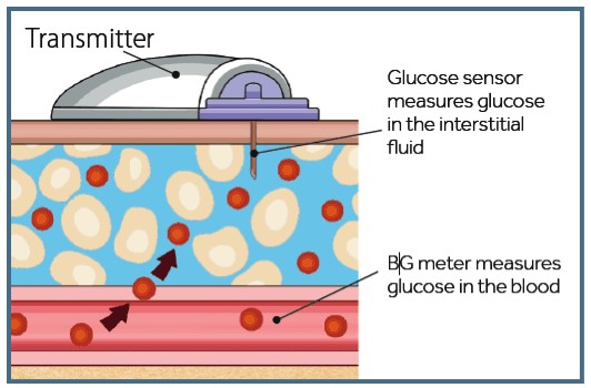 CGM Sensor obtains blood sugar level